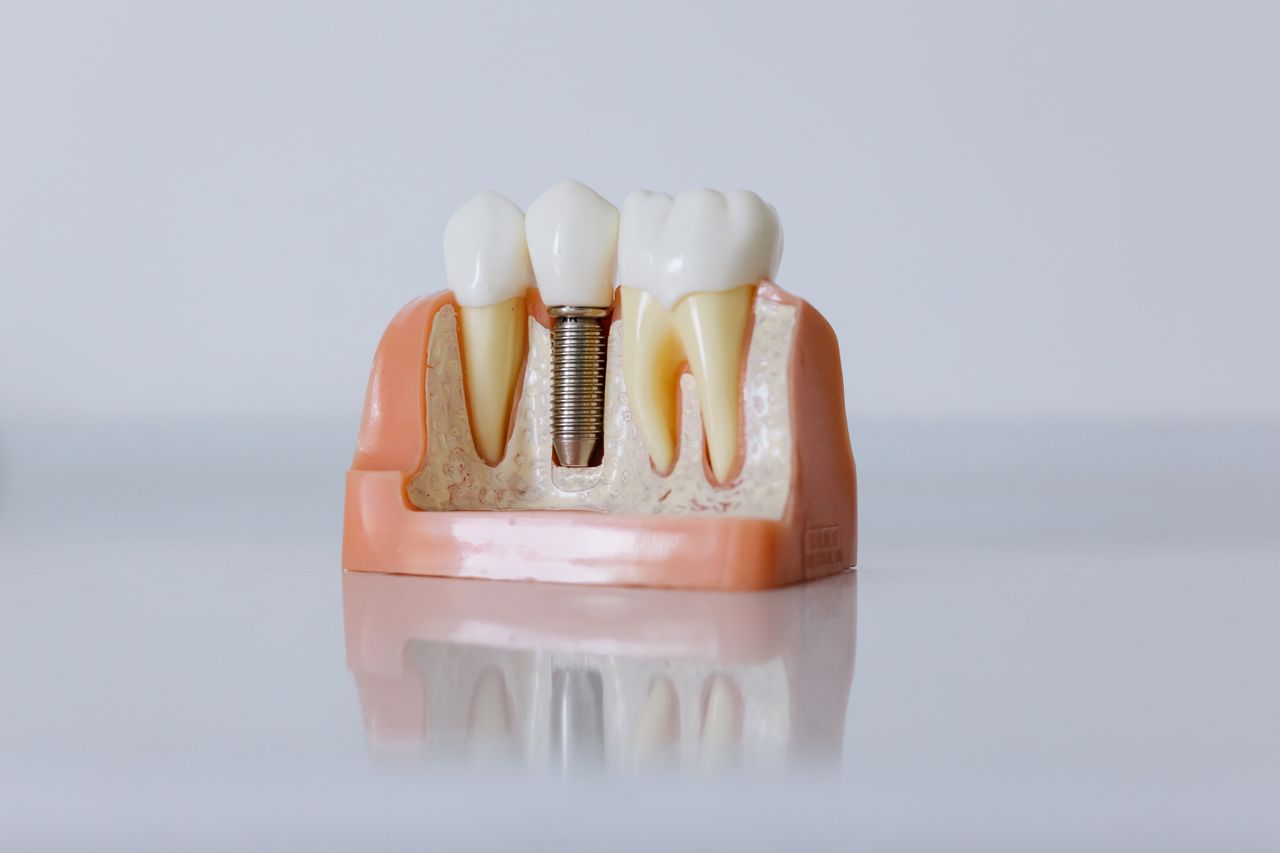 Implant dentaire